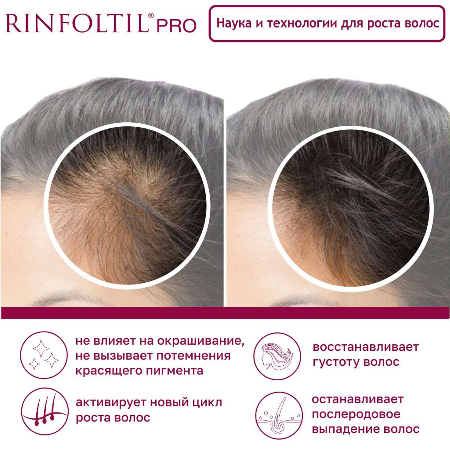 Сыворотка Rinfoltil PRO Нанолипосомальная против выпадения волос - фото 9