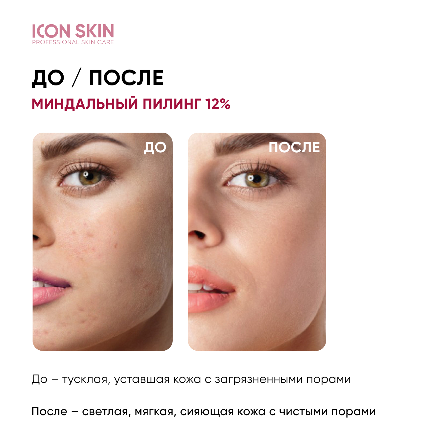 Пилинг ICON SKIN 12% миндальная смарт система 30 мл - фото 2