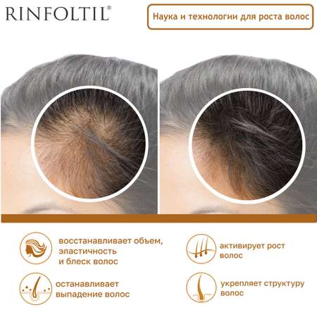 Сыворотка Rinfoltil Липосомальная против выпадения волос. При любом типе выпадения