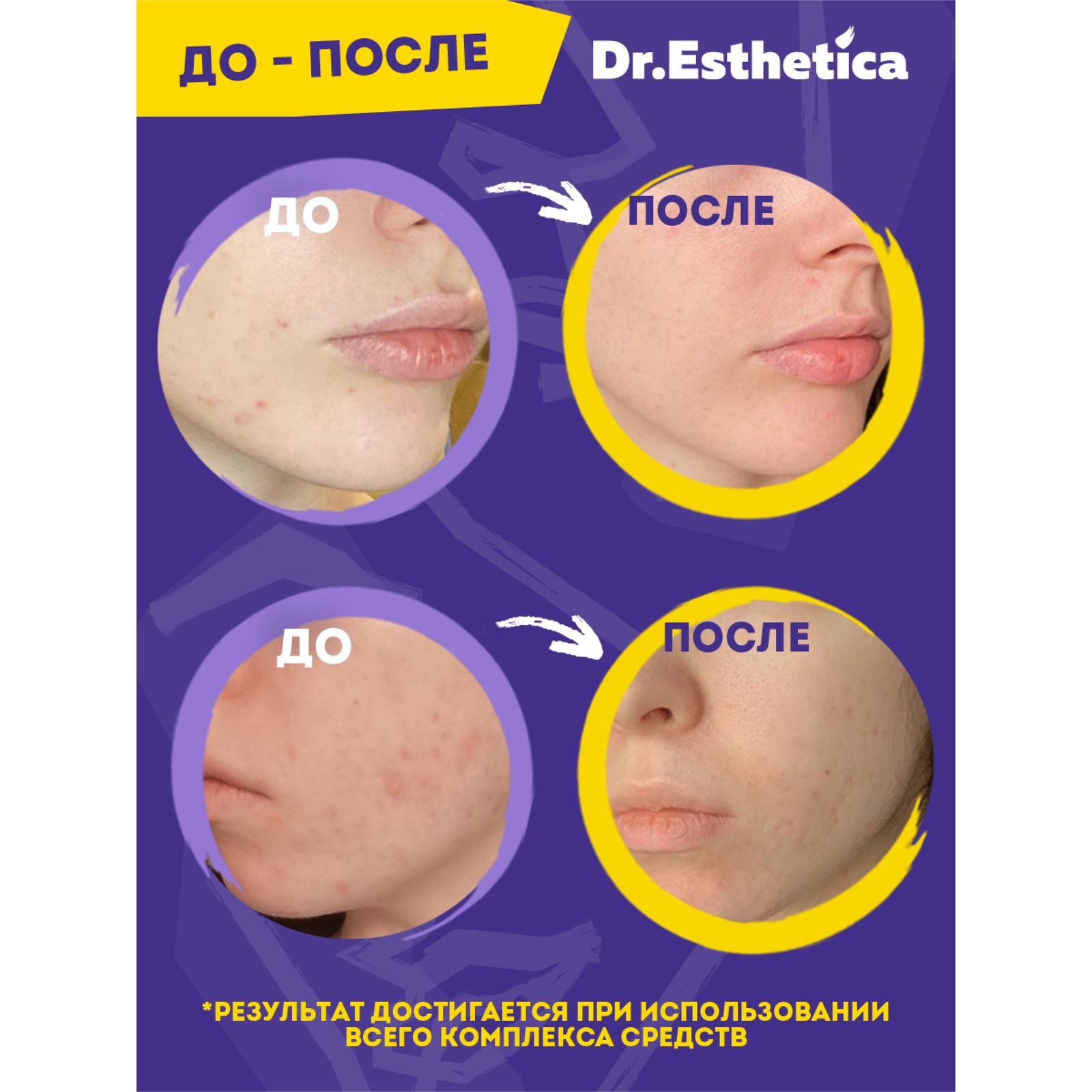 Крем-актив Dr. Esthetica против прыщей 50 мл - фото 8