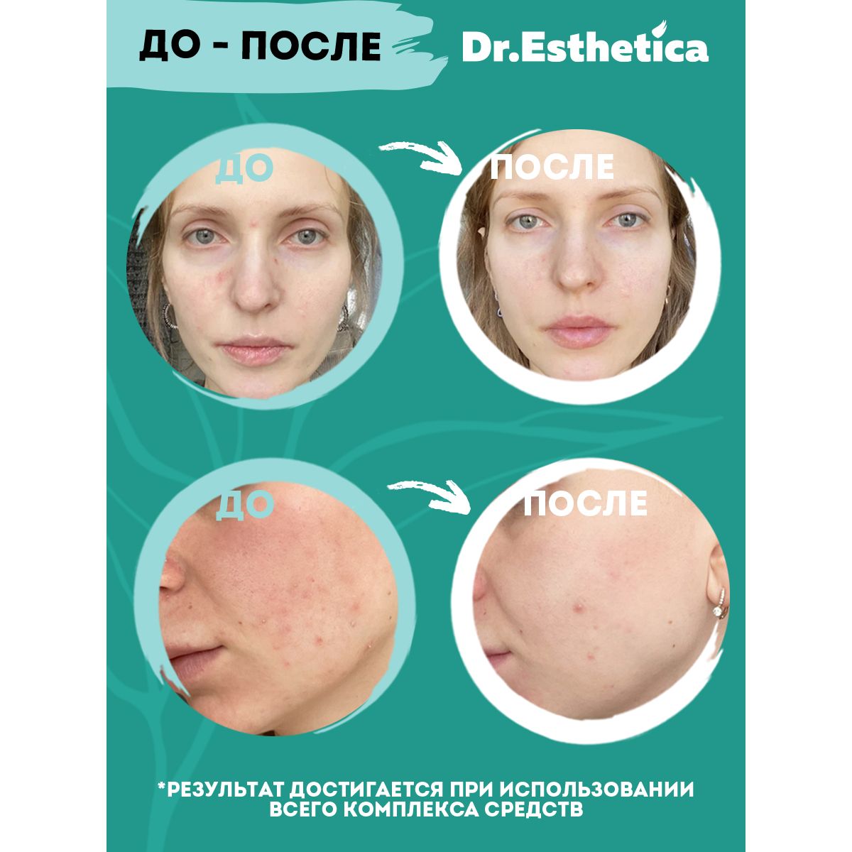 Пенка-баланс Dr. Esthetica очищающая от прыщей 200 мл - фото 9