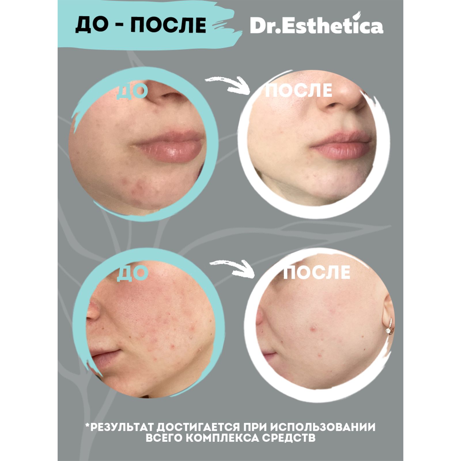 Гель-корректор Dr. Esthetica от прыщей 15 мл - фото 7