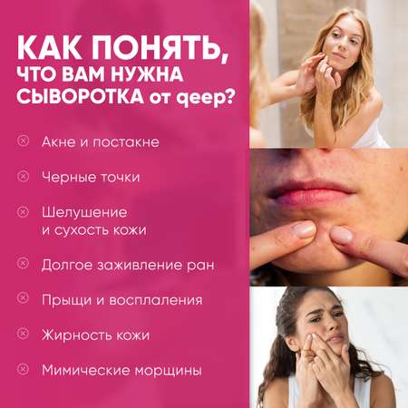 Сыворотка qeep отбеливающая для лица от прыщей и угрей