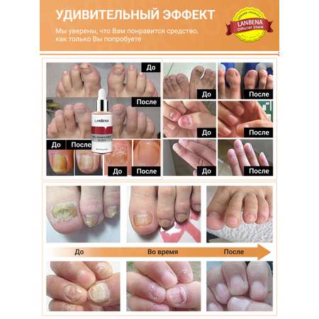 Эссенция LANBENA Средство от грибка ногтей на ногах