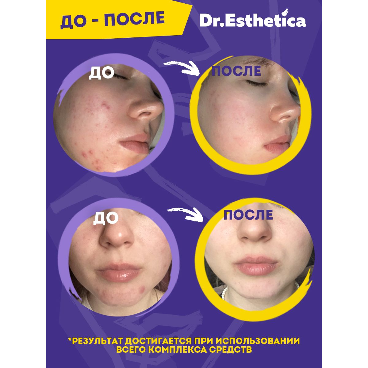 Пенка-актив Dr. Esthetica очищающая от прыщей 200 мл купить по цене 384 ₽ в  интернет-магазине Детский мир