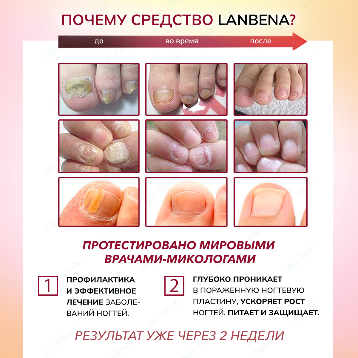 Бесцветный гель LANBENA Средство для ногтей от грибка на ногах - фото 3