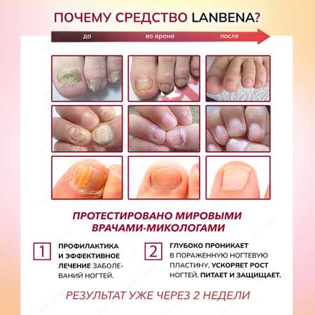 Бесцветный гель LANBENA Средство для ногтей от грибка на ногах