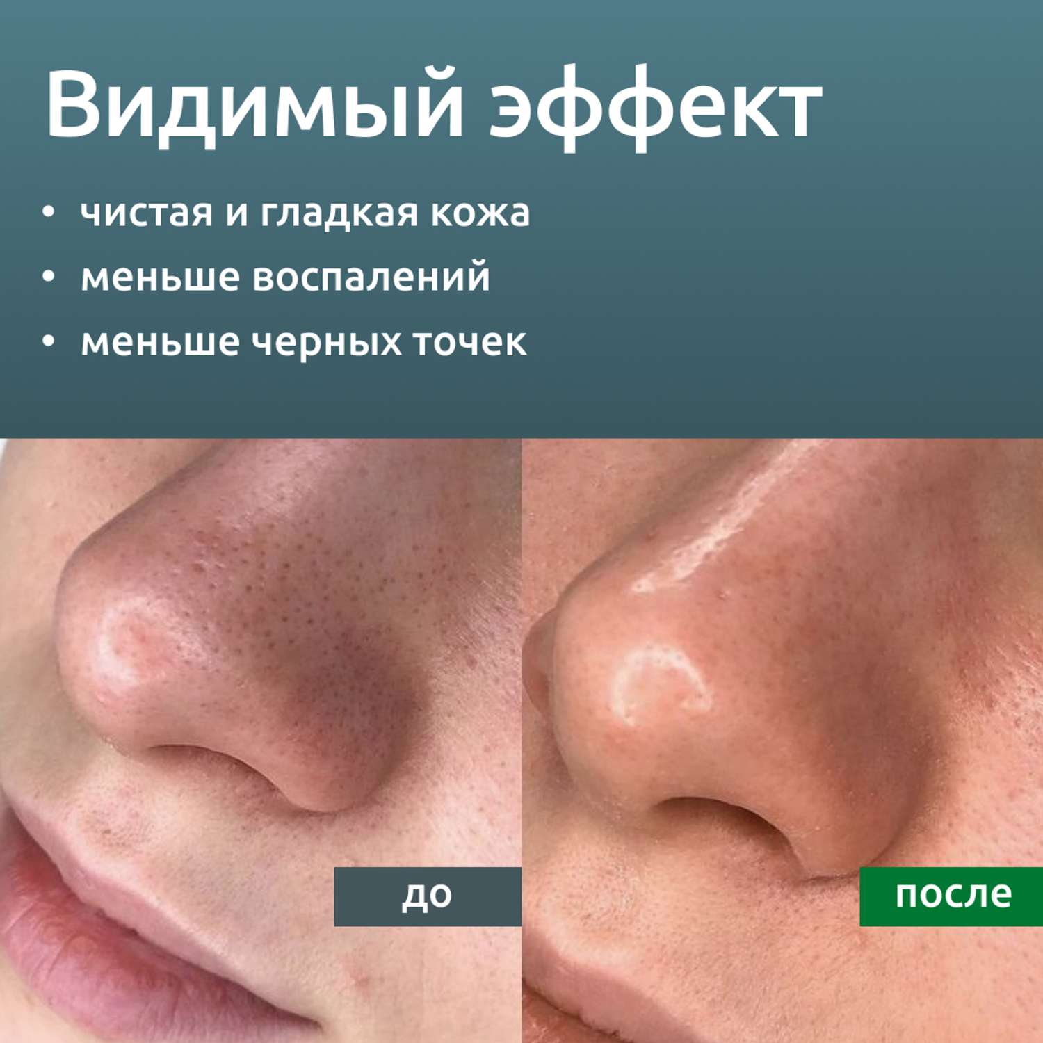 Гель для УЗ чистки лица ReadySkin Care Ultraclean Gel - фото 6