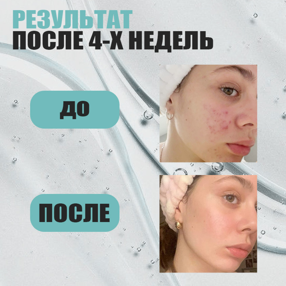 Гель для умывания EDEN Stop Acne против высыпаний 150мл - фото 3