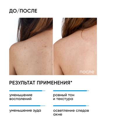 Сыворотка ICON SKIN спрей от акне на теле acne free solution