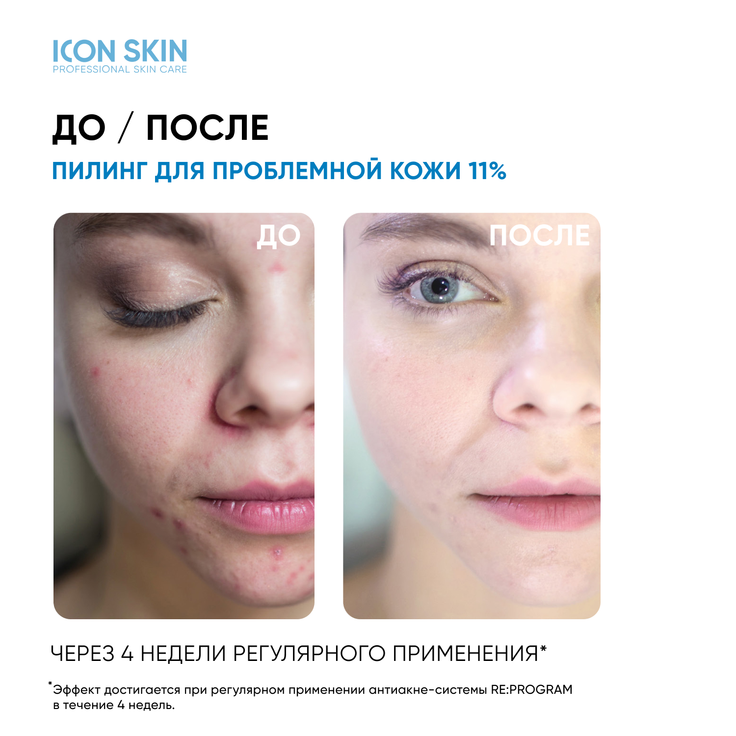 Пилинг ICON SKIN для проблемной кожи 11% 30 мл